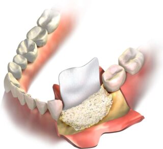 Gum & Bone Grafting  North York